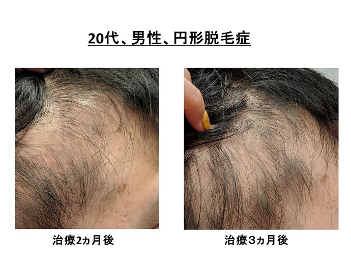 円形脱毛症　病院